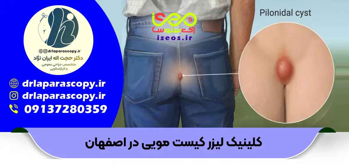 بهترین جراح کیست مویی در اصفهان